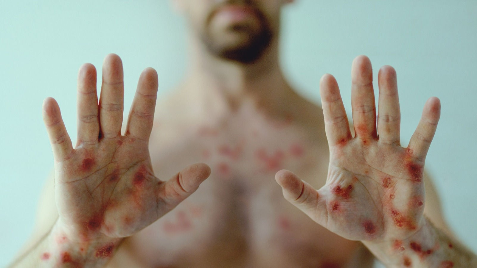 A mpox pode causar manchas vermelhas que evoluem para bolhas cheias de pus